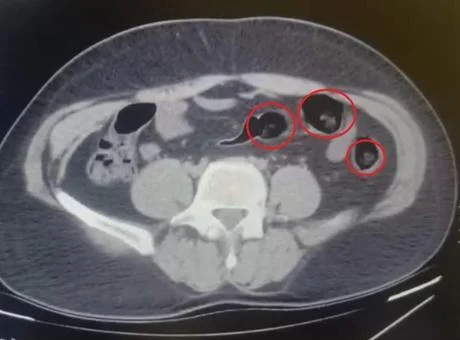 Yolcu otobüsünde şoke eden operasyon! Mide ve bağırsaklarından yarım kilo uyuşturucu çıktı